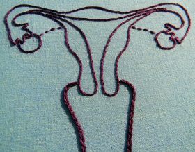 lesbian hysterectomy